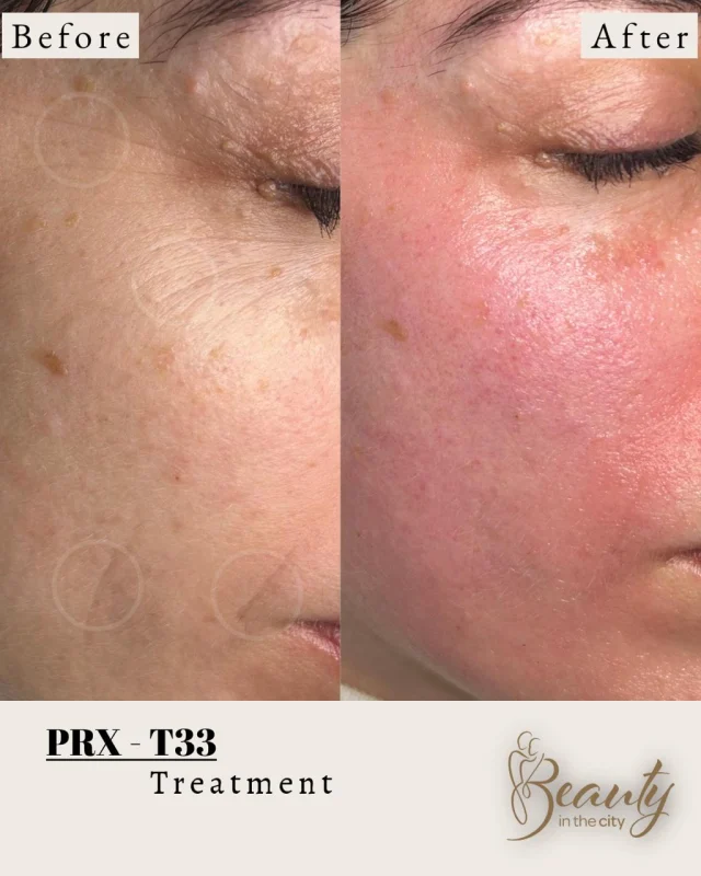 Before and after a PRX-T33 treatment on the cheek at Beauty in the City