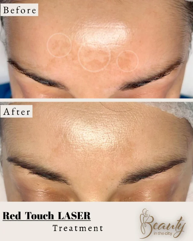 Before and after a Red Touch laser treatment on the forehead at Beauty in the City