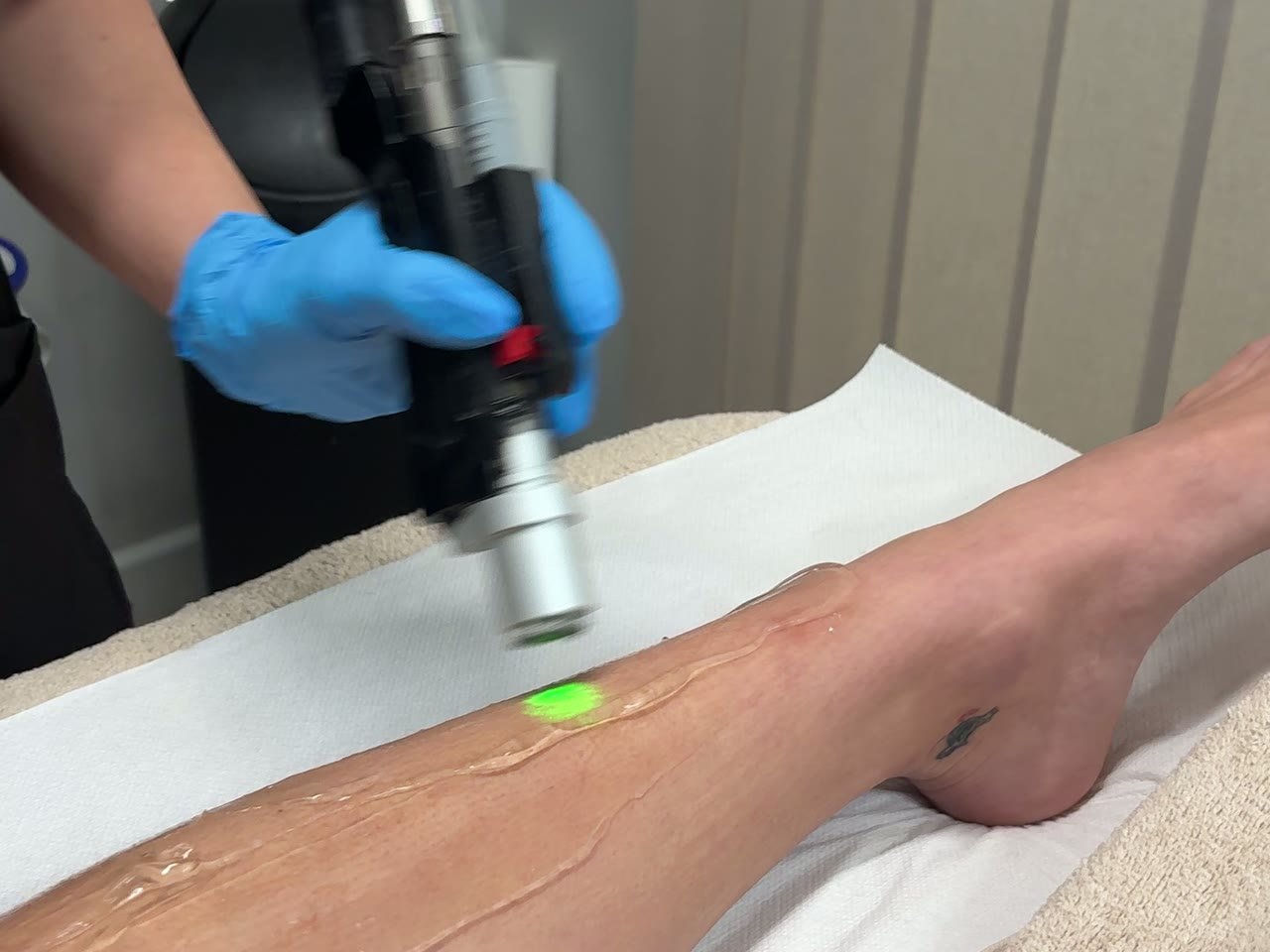 A laser hair removal treatment on the leg at Beauty in the City